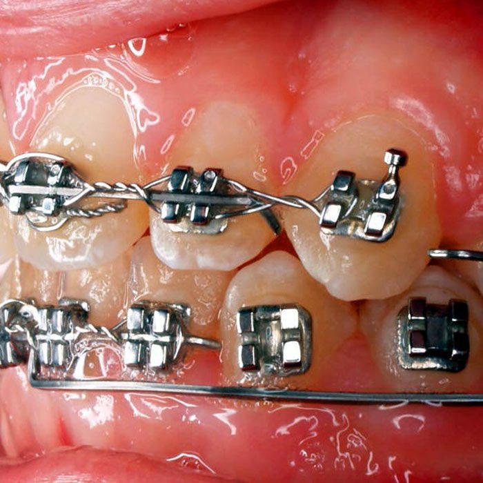 braces anatomy 2022 700 Scripps Poway Orthodontics
