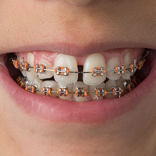 braces myths 2025 543 Scripps Poway Orthodontics