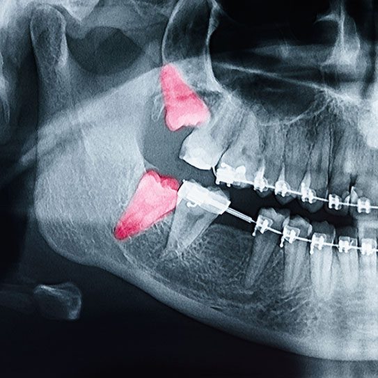 wisdom teeth braces 2025 543 Scripps Poway Orthodontics