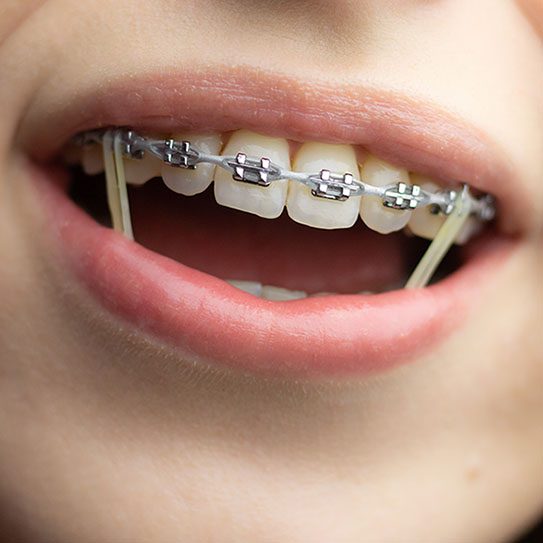 braces anatomy 2025 543 Scripps Poway Orthodontics
