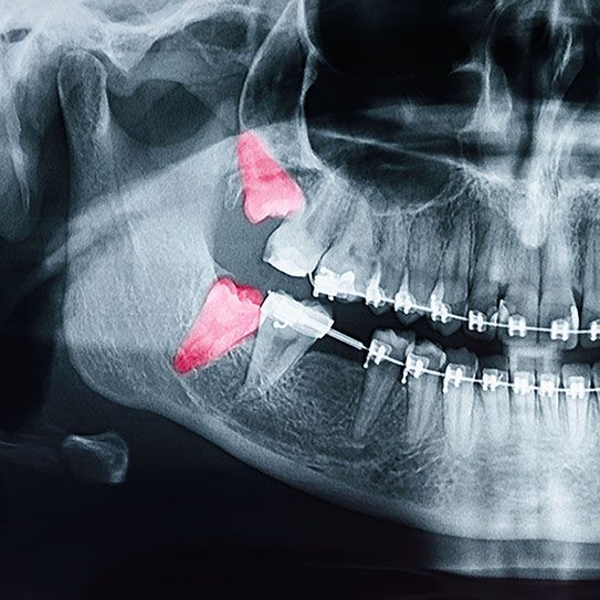 wisdom teeth braces 2026 543 Scripps Poway Orthodontics