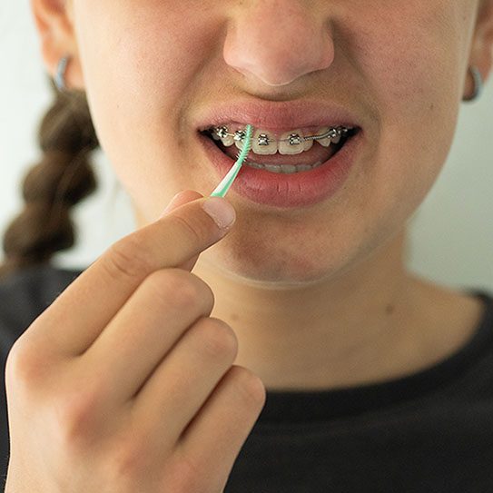 avoiding stains braces 2026 543 Scripps Poway Orthodontics