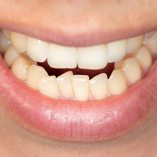 why crooked teeth 2026 543 Scripps Poway Orthodontics