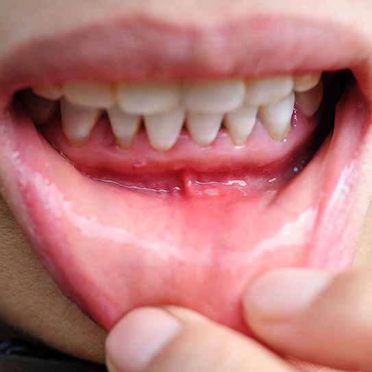 gum recession 2026 543 Scripps Poway Orthodontics